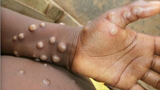 La variole du singe
